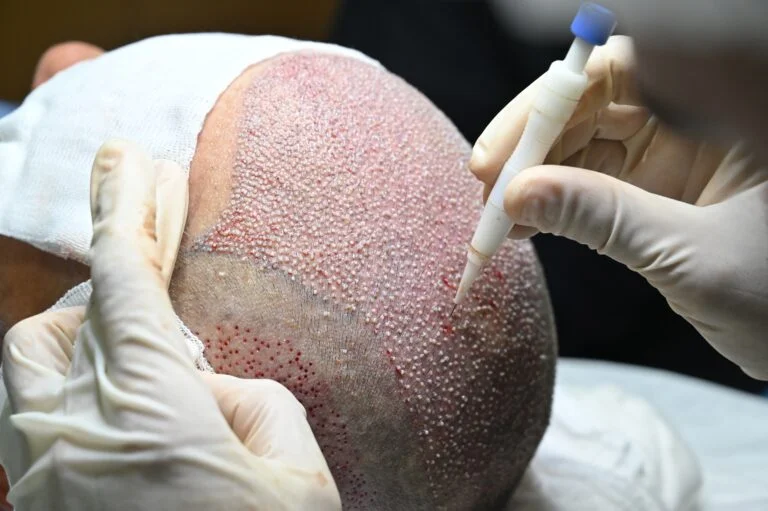 تقنية زراعة الشعر بالاقتطاف FUE