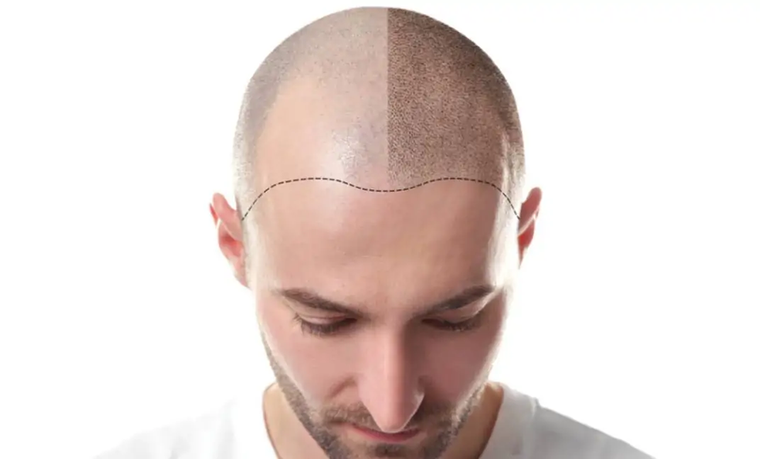 خطوات عملية زراعة الشعر في مصر