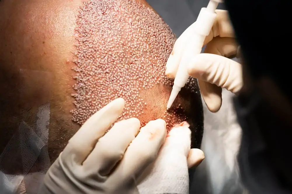 فوائد عمليات زراعة الشعر