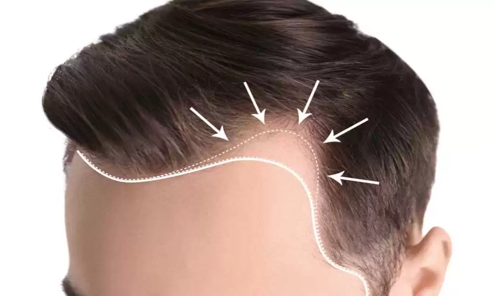 أفضل دكتور زراعة شعر للرجال