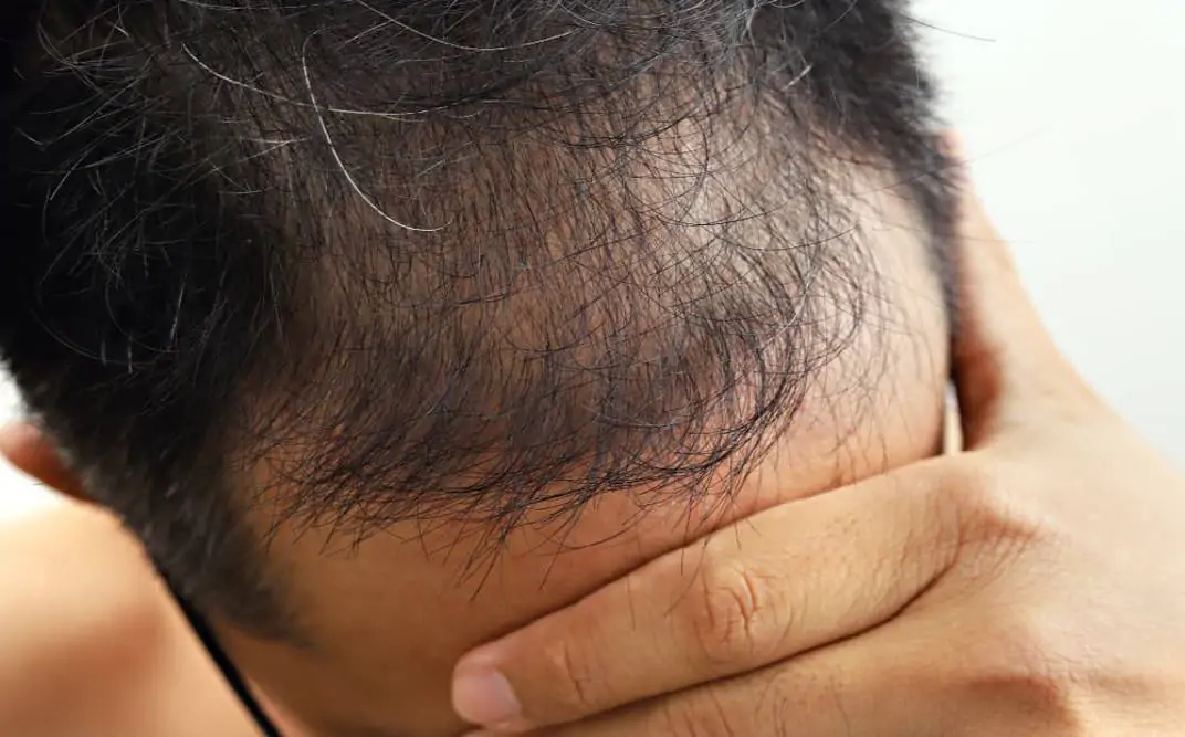 سعر تقنية smp للشعر