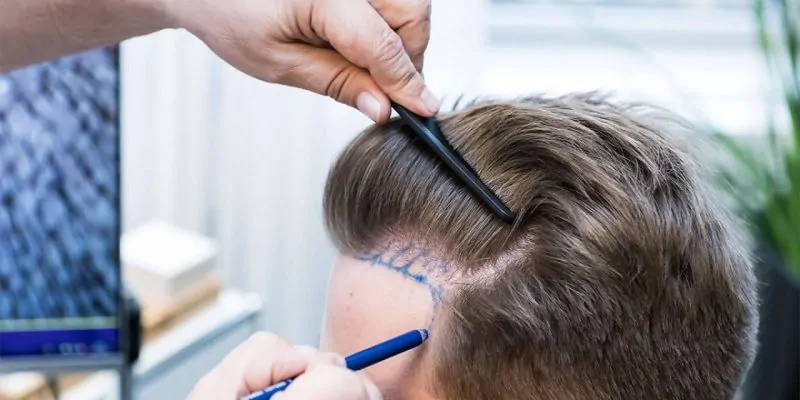 شروط نجاح عملية زراعة الشعر في مصر