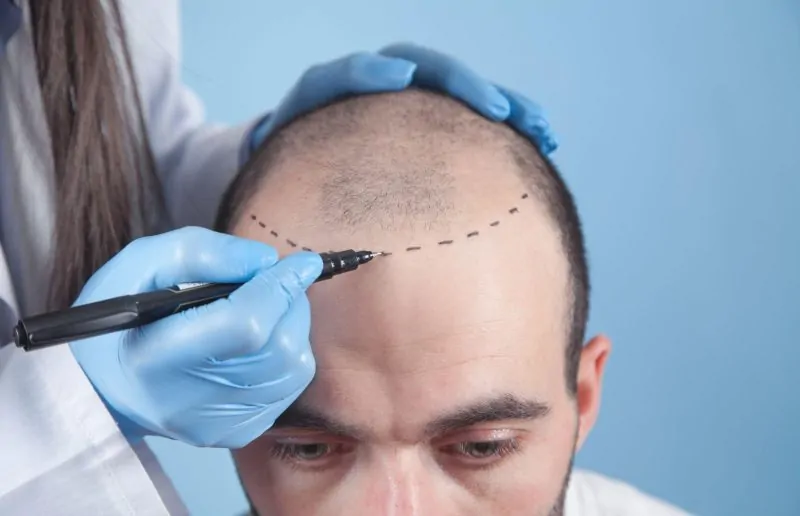 تكلفة زراعة الشعر 2025