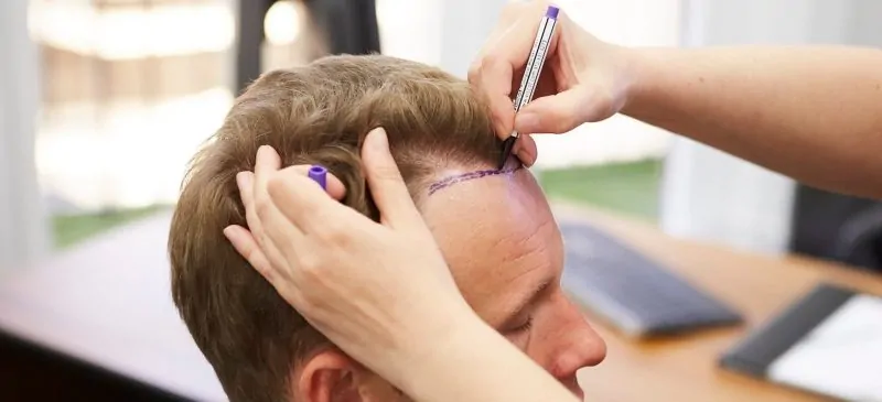 تكلفة عملية زراعة الشعر في الأردن