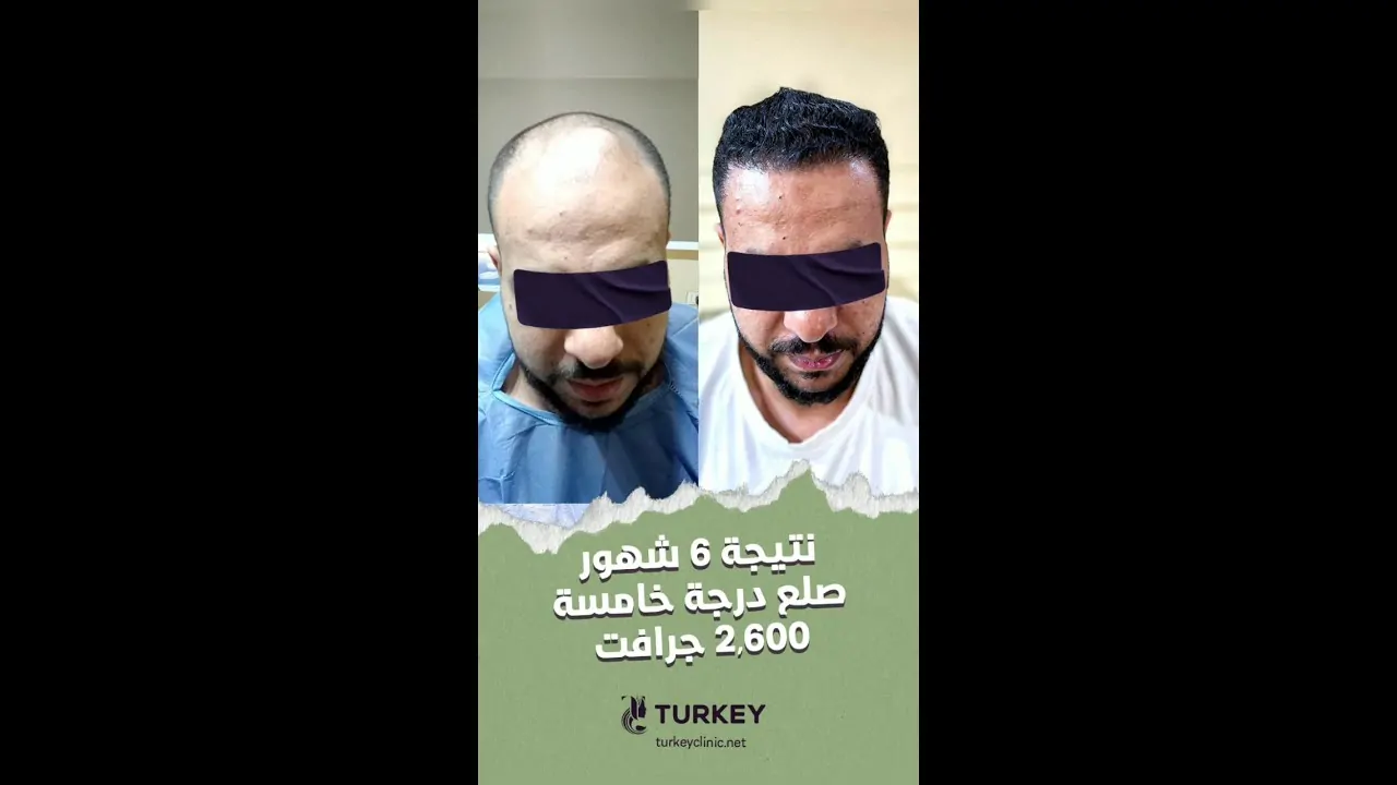 نتيجة زراعة الشعر بعد 6 شهور