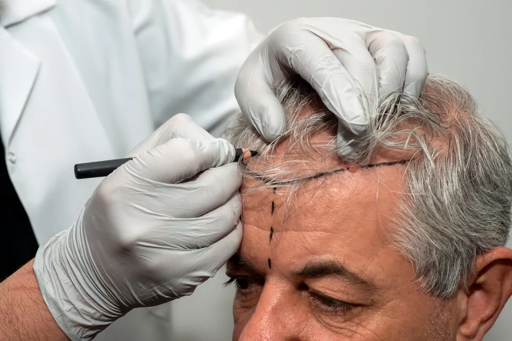 تكاليف زراعة الشعر استثمار أم مخاطرة؟ 3 زراعة الشعر بالتقسيط في مصر