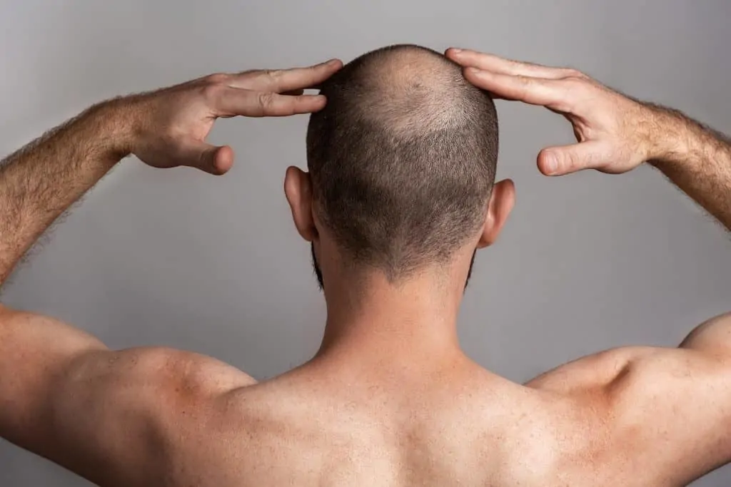 قبل وبعد زراعة الشعر في منطقة التاج
