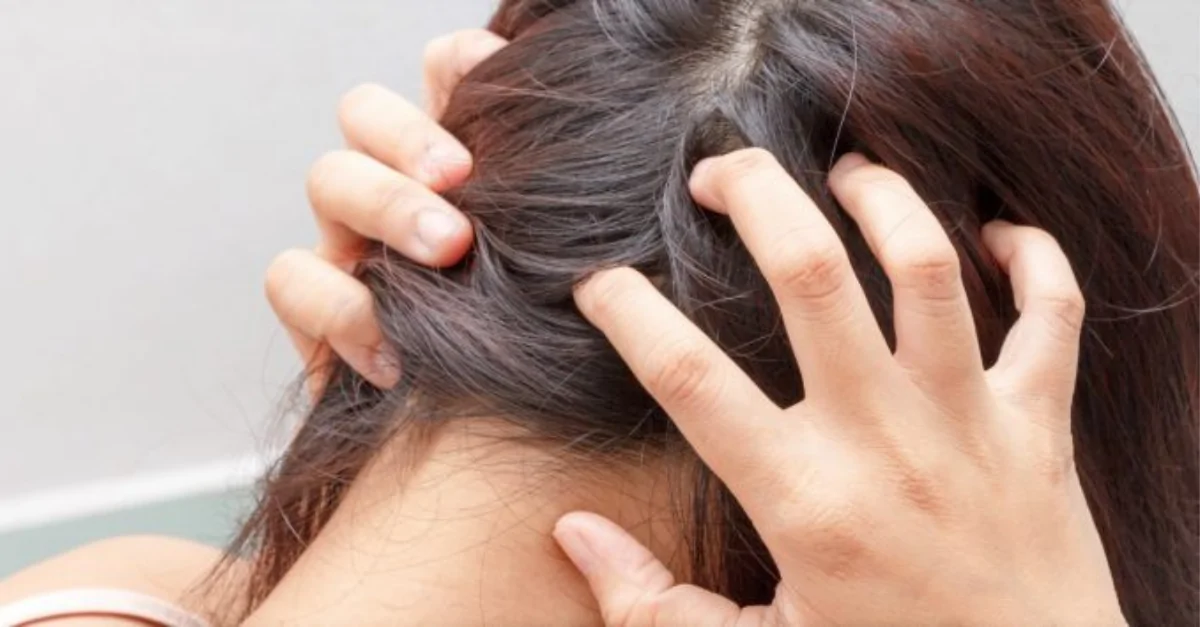 أعراض الصدفية