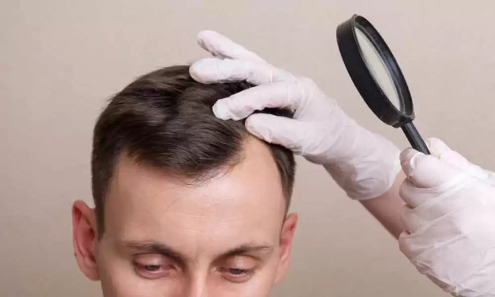الفرق بين زراعة الشعر في مصر وتركيا