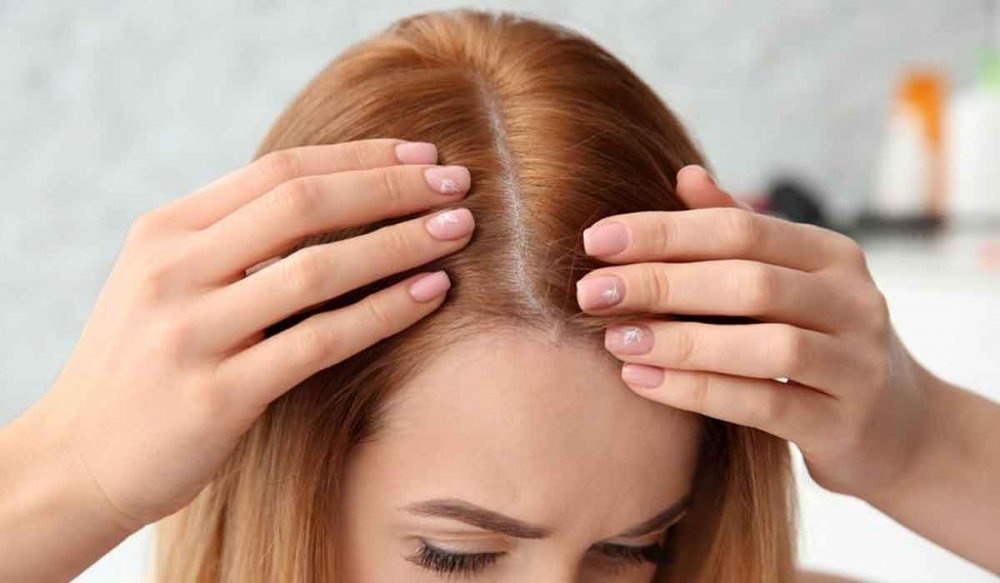 تقنية زراعة الشعر بالشريحة