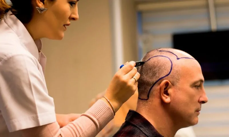 مراحل نمو الشعر بعد زراعة الشعر