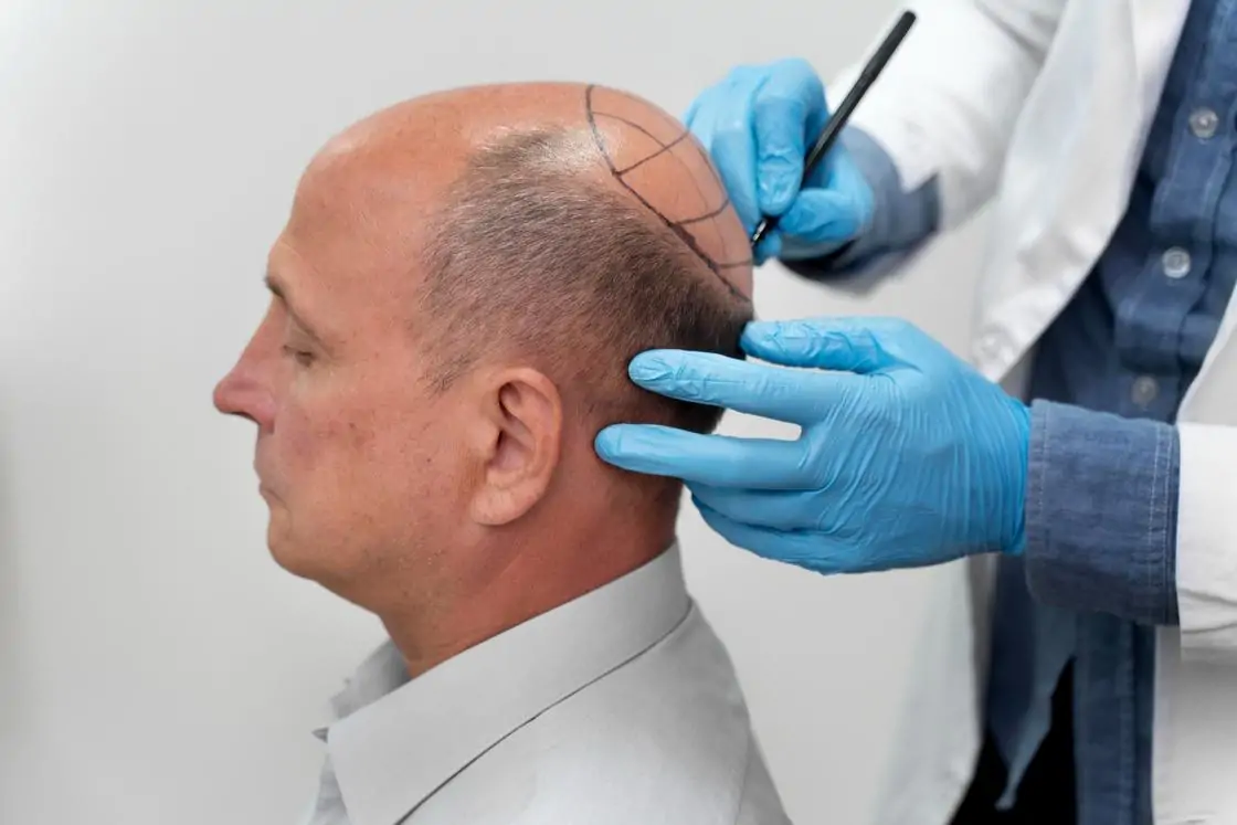 نتيجة زراعة الشعر مباشرة بعد نهاية العملية