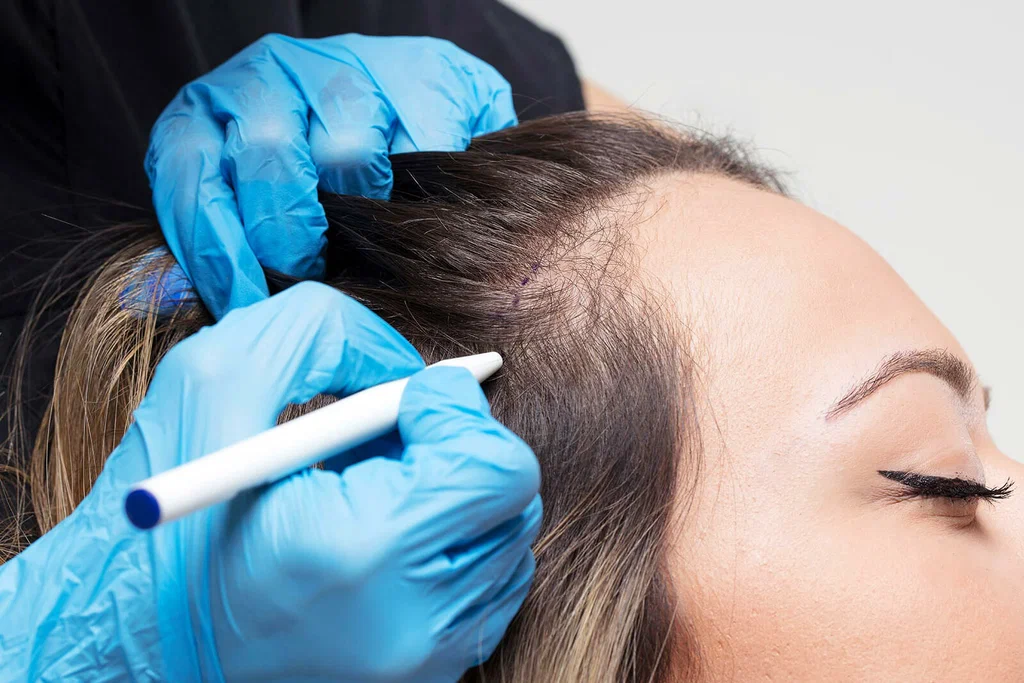 نتيجة زرع الشعر بعد شهر واحد