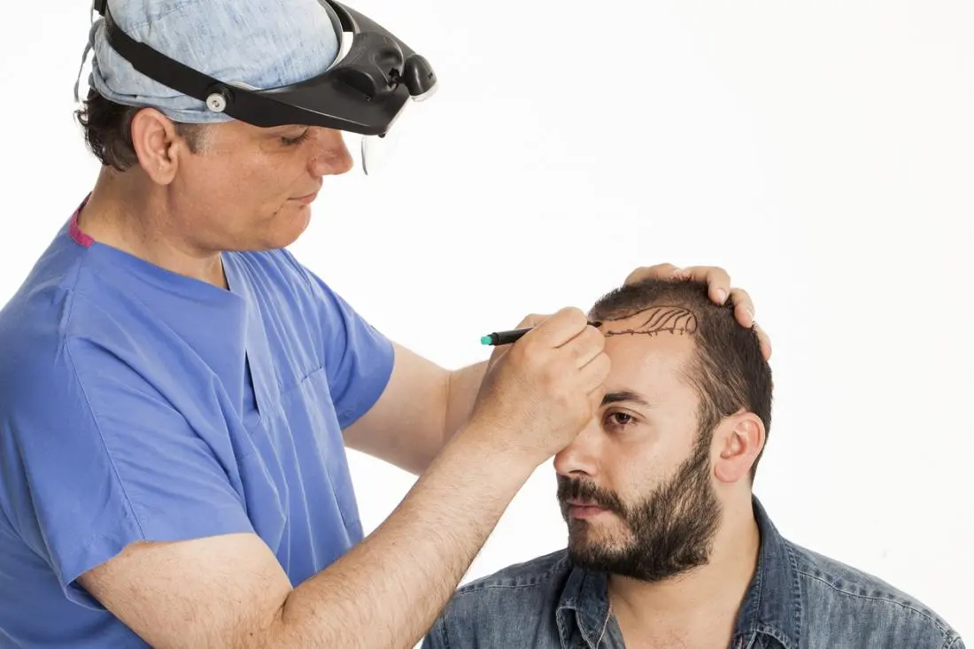 نتائج زراعة الشعر بعد 5 أشهر إلى 6 أشهر