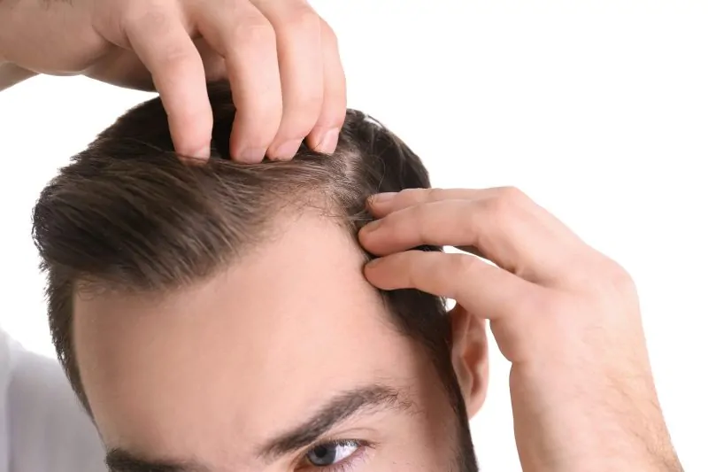 نتائج زراعة الشعر بعد 3 شهور