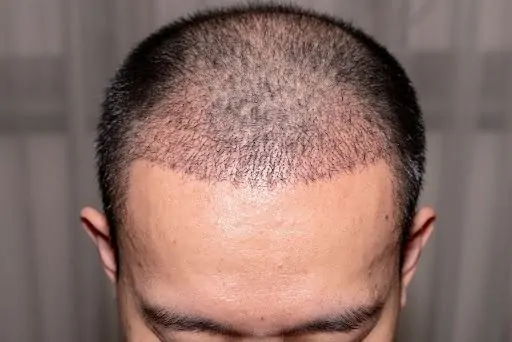 الألم بعد عملية زراعة الشعر