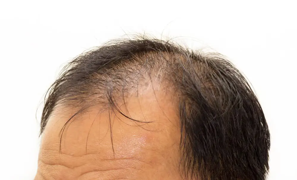 كيفية التعامل مع تورم الوجه بعد زراعة الشعر