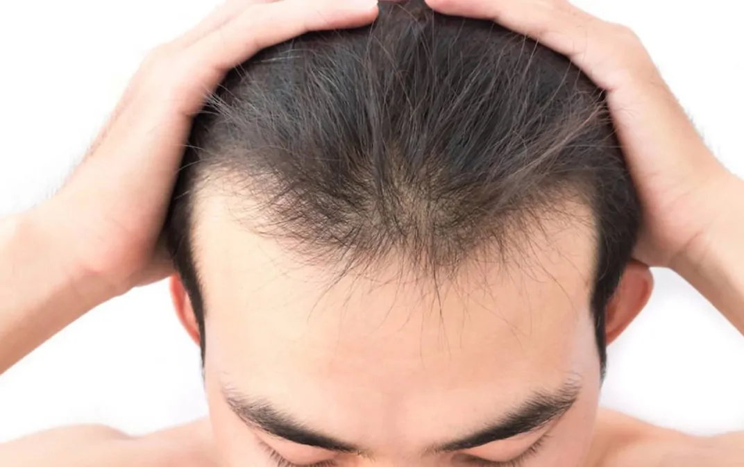 أسباب تورم الرأس بعد زراعة الشعر