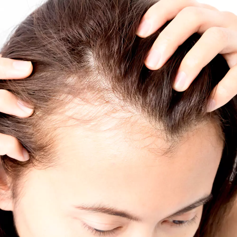 زراعة الشعر للنساء في مصر