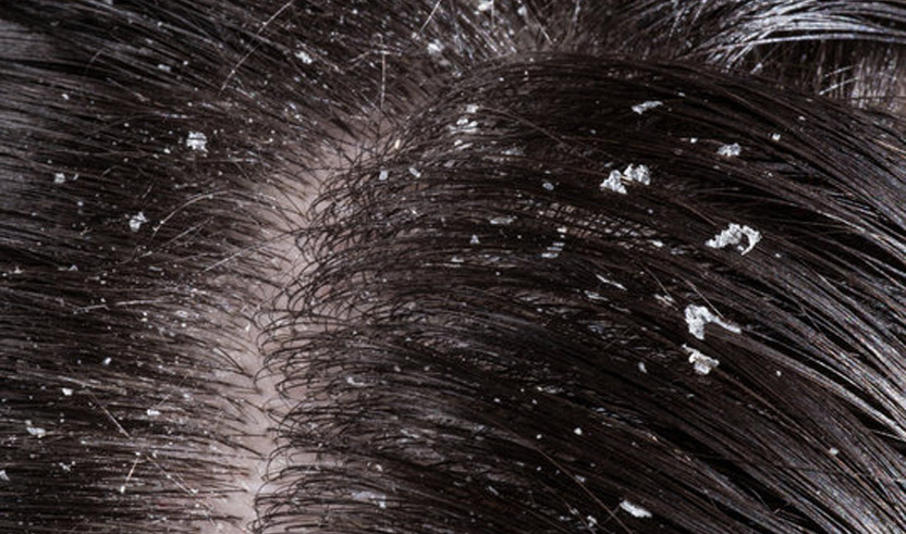 شكل القشور بعد زراعة الشعر