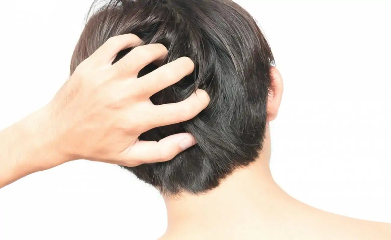 علاج حكة الراس بعد زراعة الشعر 