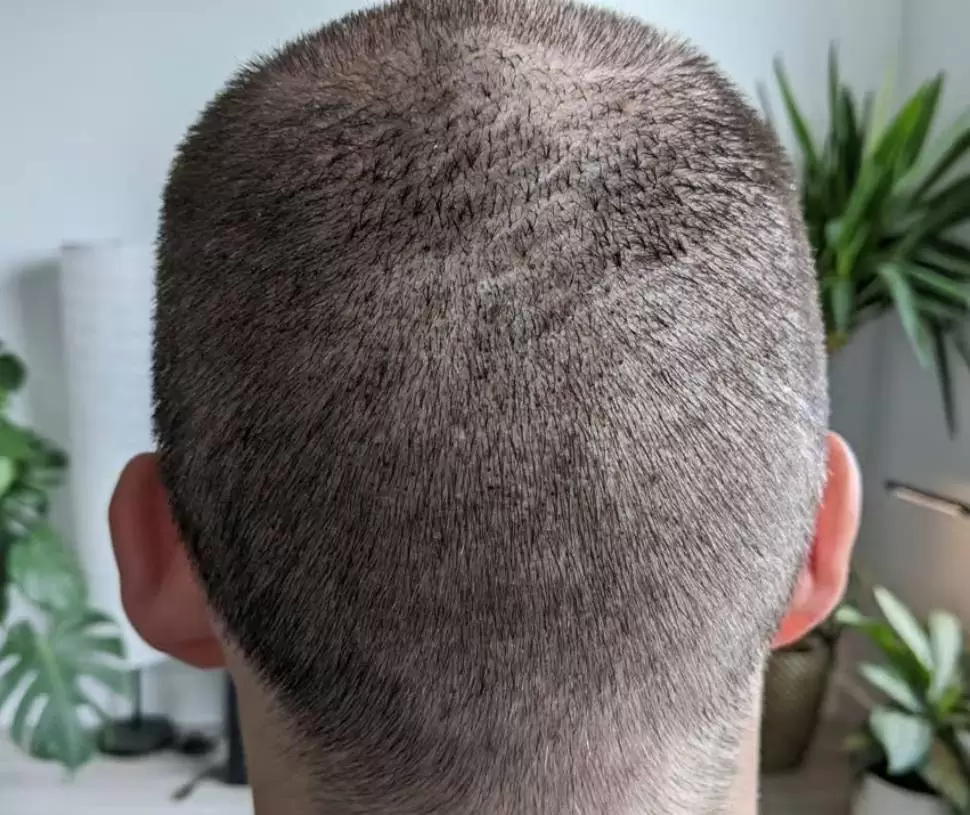 دلائل نجاح عملية زراعة الشعر