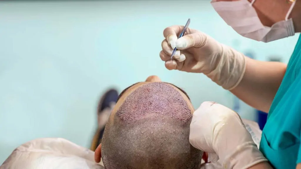 أفضل تقنيات زراعة الشعر في مصر