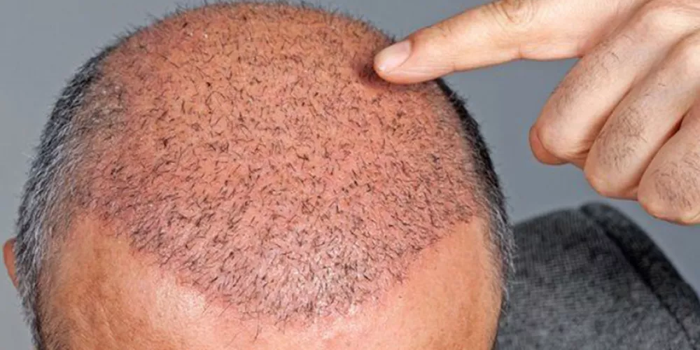 نتائج زراعة الشعر بالصور بعد 2-3 أسابيع