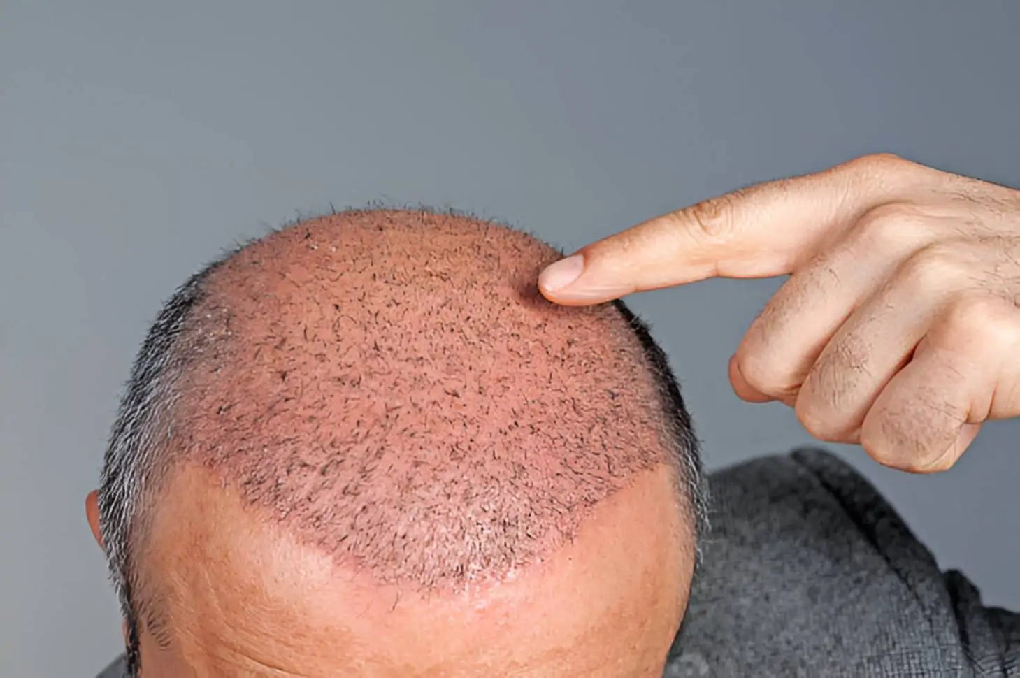 أسباب تكون القشور بعد زراعة الشعر