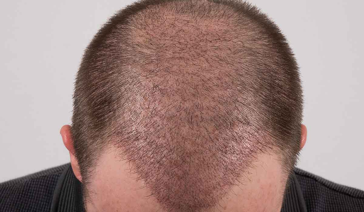 طريقة الغسيل لإزالة القشور بعد زراعة الشعر