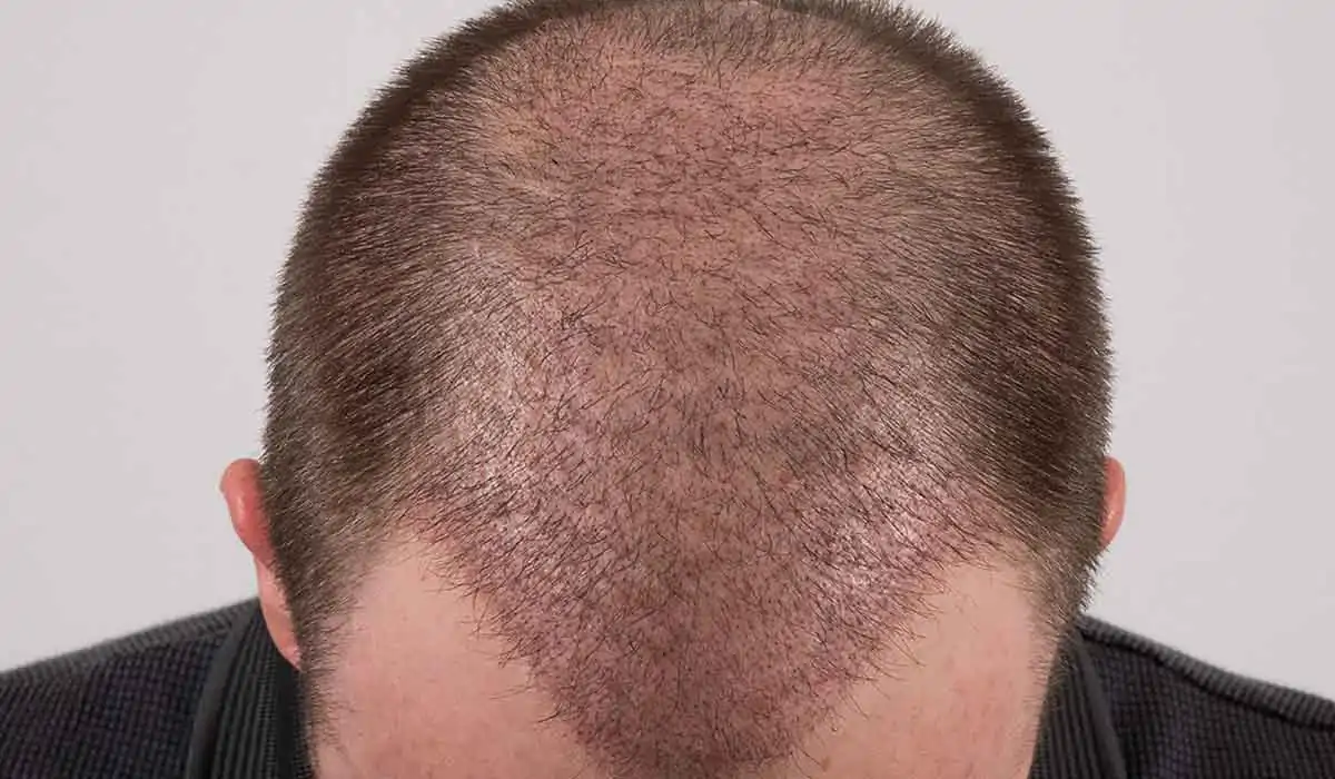 طريقة الغسيل لإزالة القشور بعد زراعة الشعر
