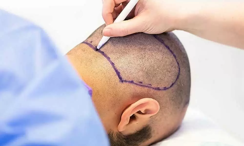 العناية بعد زراعة الشعر