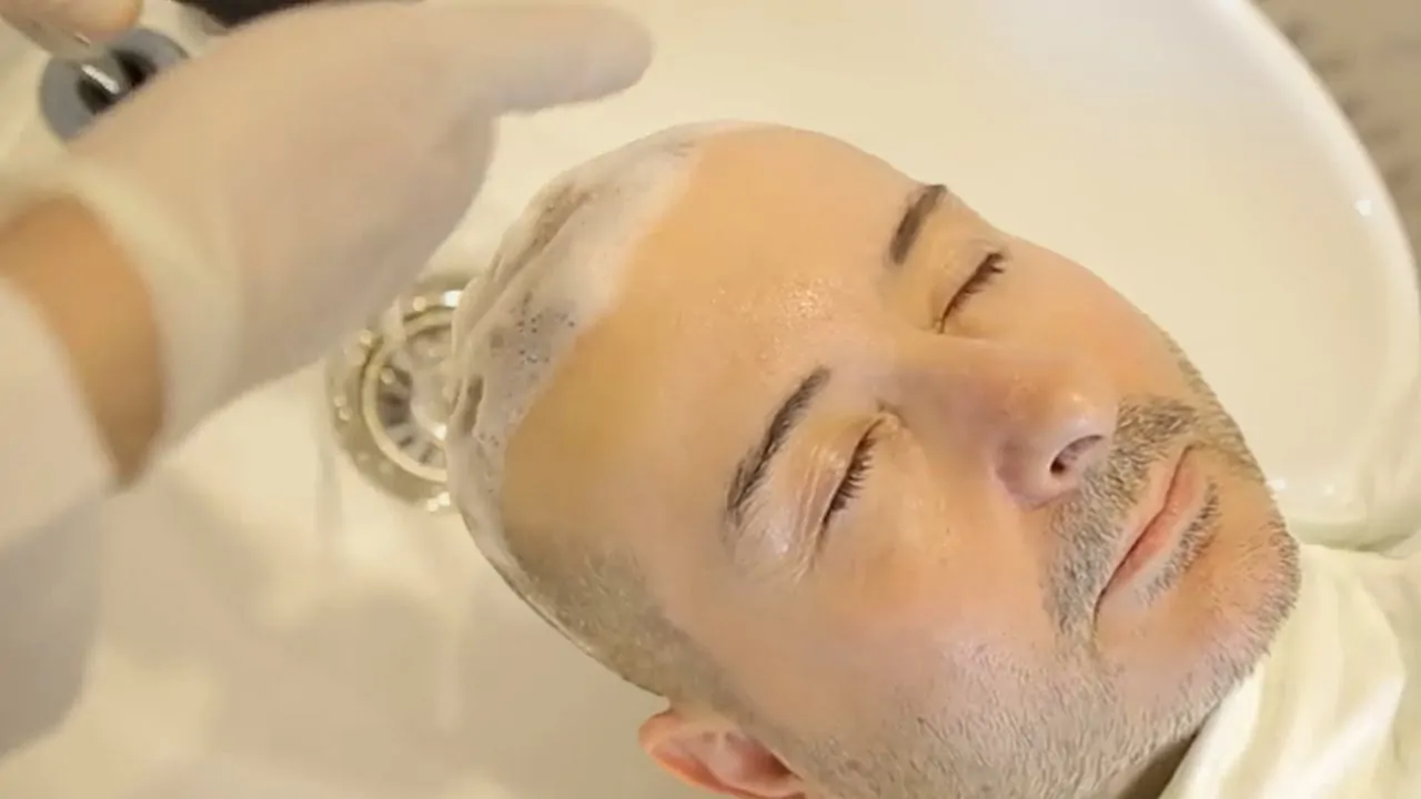 بعد 15 يوم من زراعة الشعر
