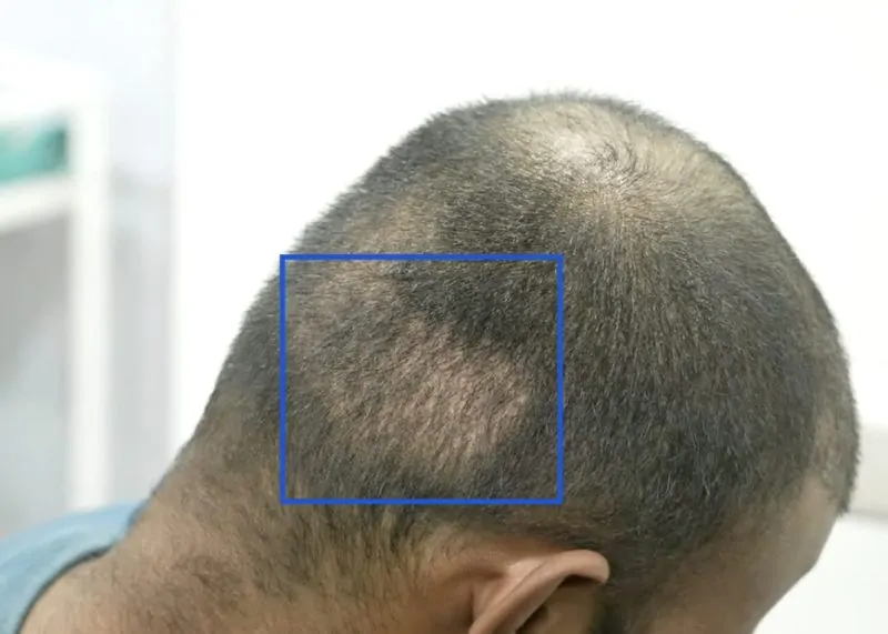 فترة التعافي بعد زراعة الشعر