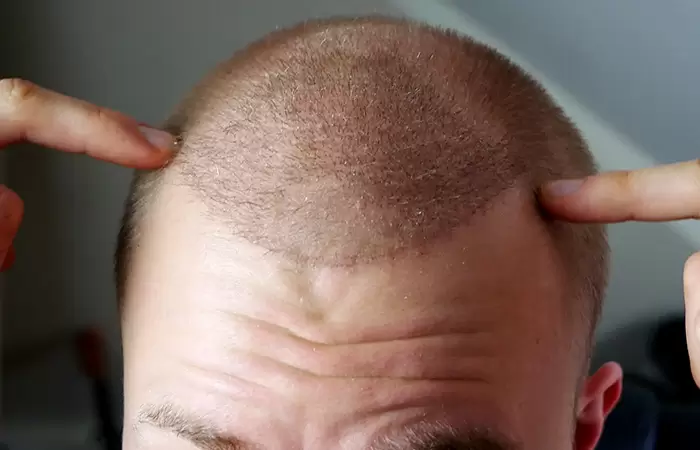 نصائح بعد عملية زراعة الشعر