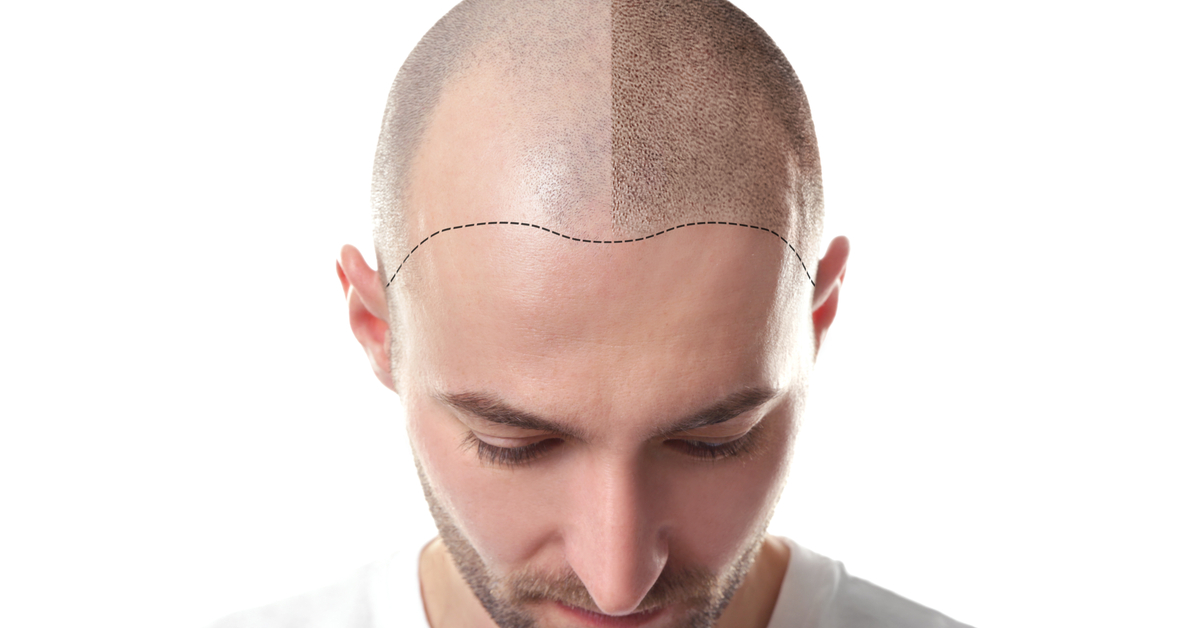 أضرار زراعة الشعر
