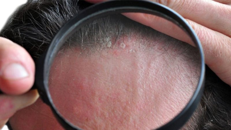 الدمامل أو التهاب الجريبات من أضرار زراعة الشعر
