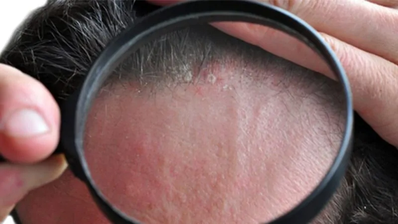 اسباب الحبوب بعد عملية زراعة الشعر وكيف يتم علاجها 6 الدمامل أو التهاب الجريبات من أضرار زراعة الشعر