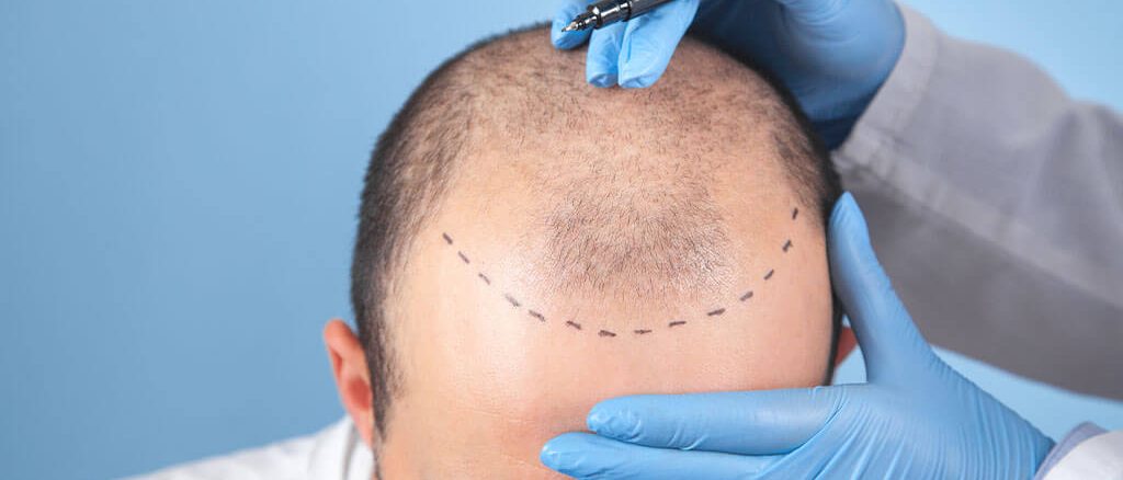 الاقتطاف أفضل تقنية لزراعة الشعر (FUE)