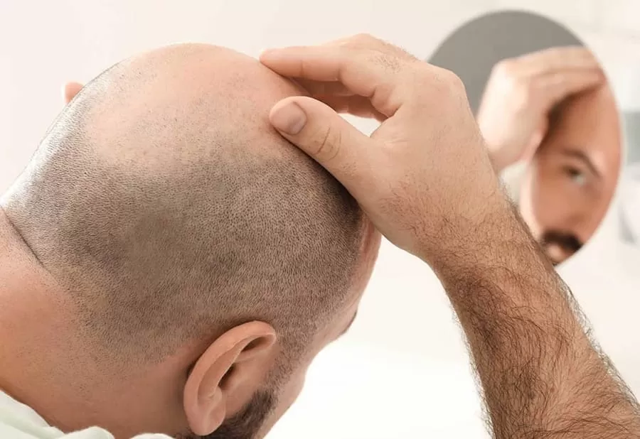 التهاب المنطقة المانحة بعد زراعة الشعر