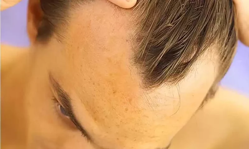 شاهد تجربتي مع عملية تصغير الجبهة الناجحة في مركز تركي كلينك 7 تصغير الجبهة عن طريق رفع الحواجب