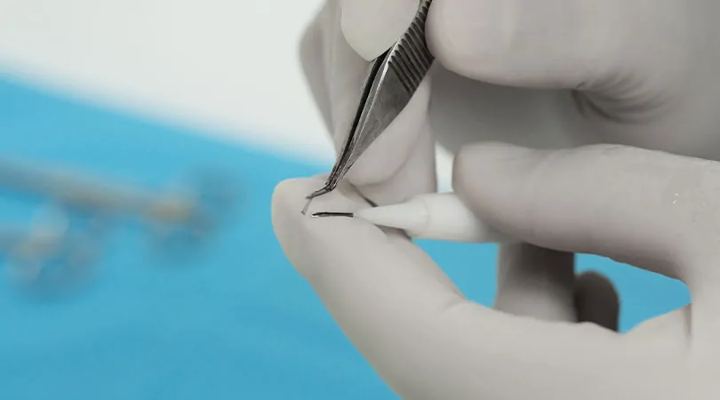 فتح القنوات في زراعة الشعر