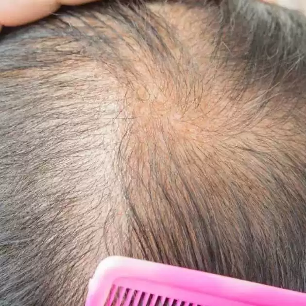 علاج فراغات الشعر (3)