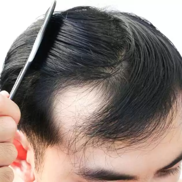 كيفية زراعة الشعر (1)