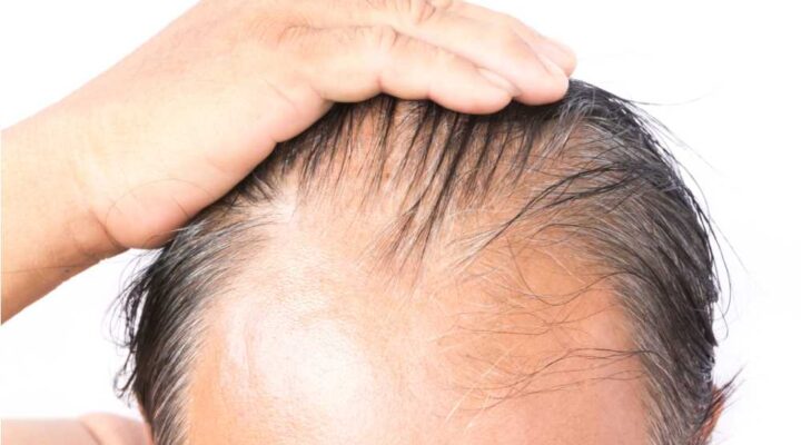 زراعة الشعر في مقدمة الراس
