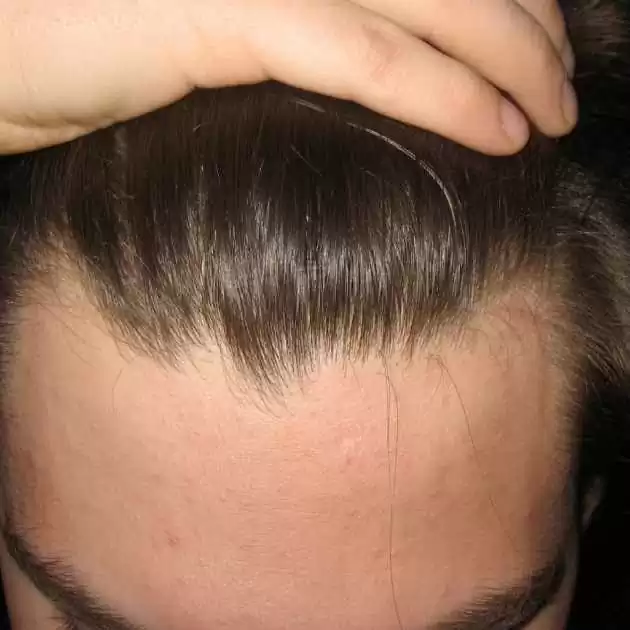 زراعة خط الشعر الامامي (1)