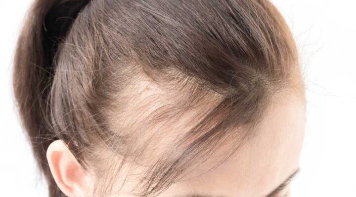 زراعة شعر مقدمة الرأس للنساء