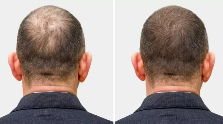 هل زراعة الشعر ناجحة