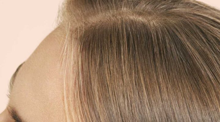 زراعة الشعر للسيدات