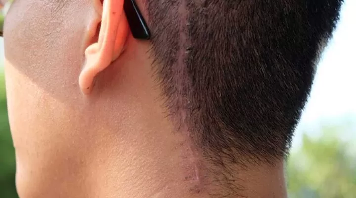 زراعة الشعر مكان الجروح